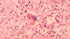 Person with measles visited Boston, health officials warn